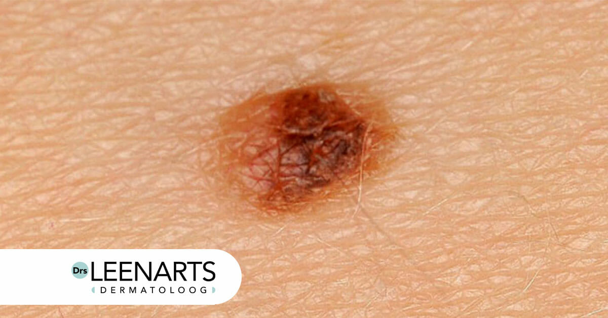 dermatoloog moedervlek controleren dermatoloog moedervlek controleren