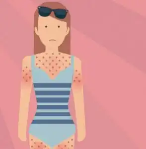 Hoe ontstaat zonneallergie? | Drs Leenarts | Dermatoloog