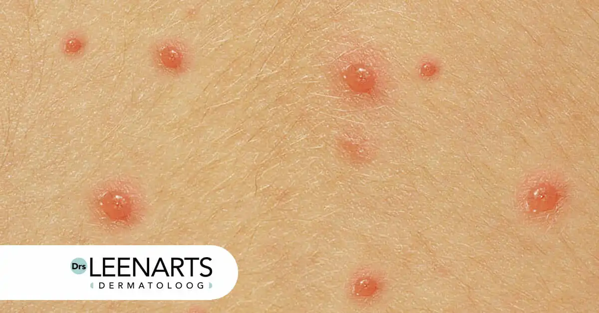 Wat te doen bij waterpokken? Drs Leenarts Dermatoloog