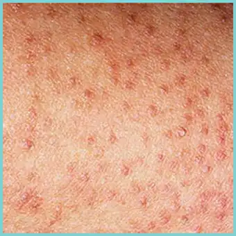 foto keratosis-pilaris-rode-bultjes-op-armen-en-benen-voorbeeld-huidaandoening-dermatoloog