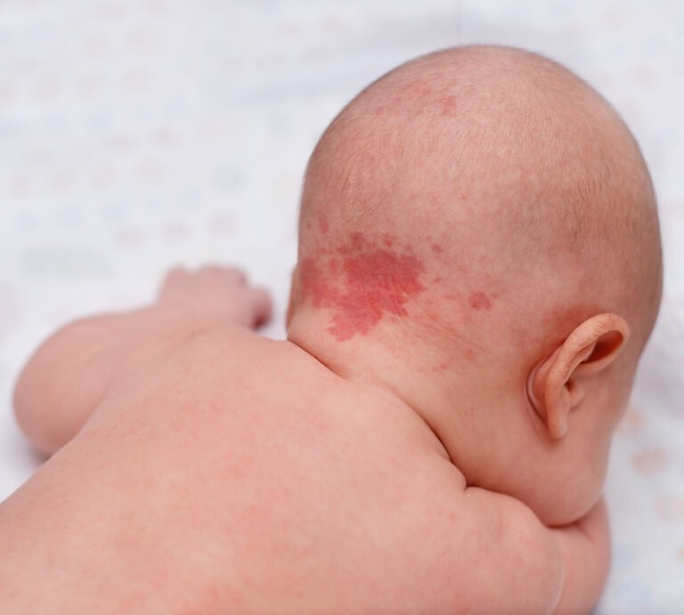 Drs Leenarts blog over baby met Rode geboortevlek: ooievaarsbeet of engeltjeskus?