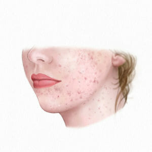 Acne