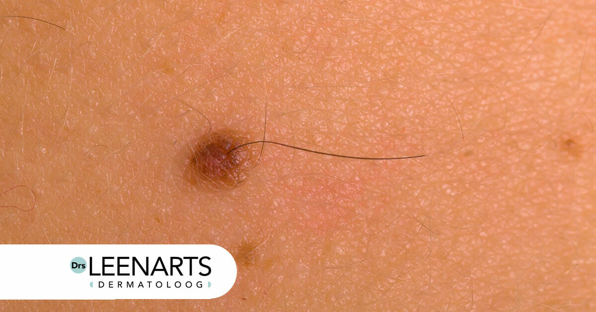 dermatoloog moedervlek