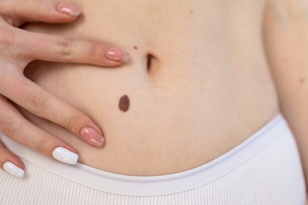 Hoe controleer ik een moedervlek? | Drs Leenarts