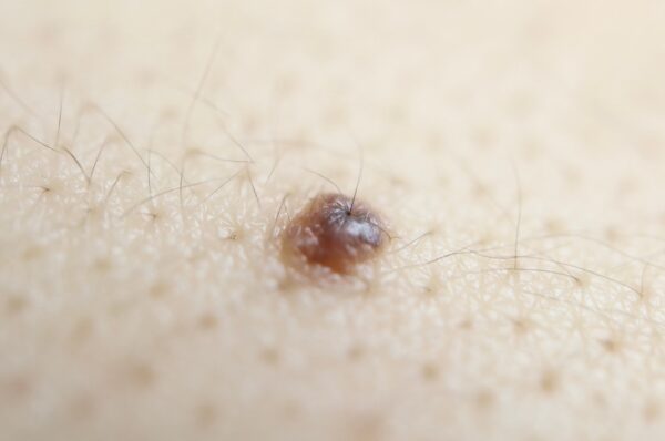 Jeukende moedervlek, kan het kwaad? I Advies | Drs Leenarts