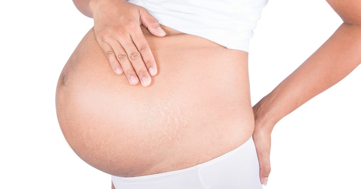 Zwangerschapsstriemen of striae voorkomen, kan dat eigenlijk?