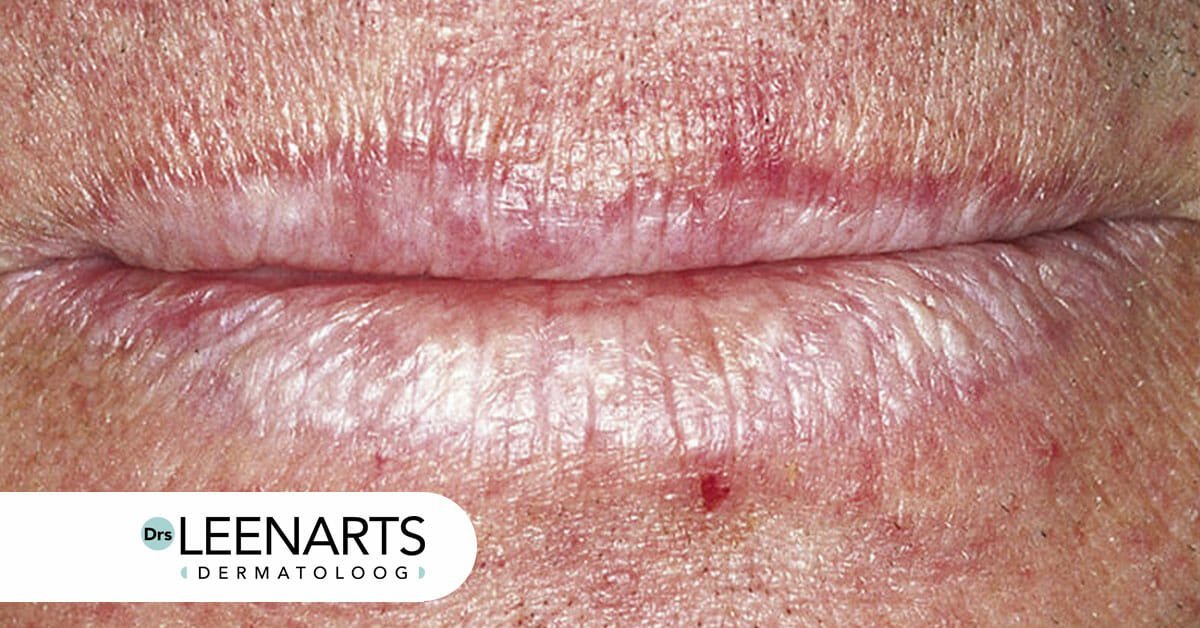 SPF bescherming lippen schade schilfering blaasjes Drs. Leenarts Dermatoloog