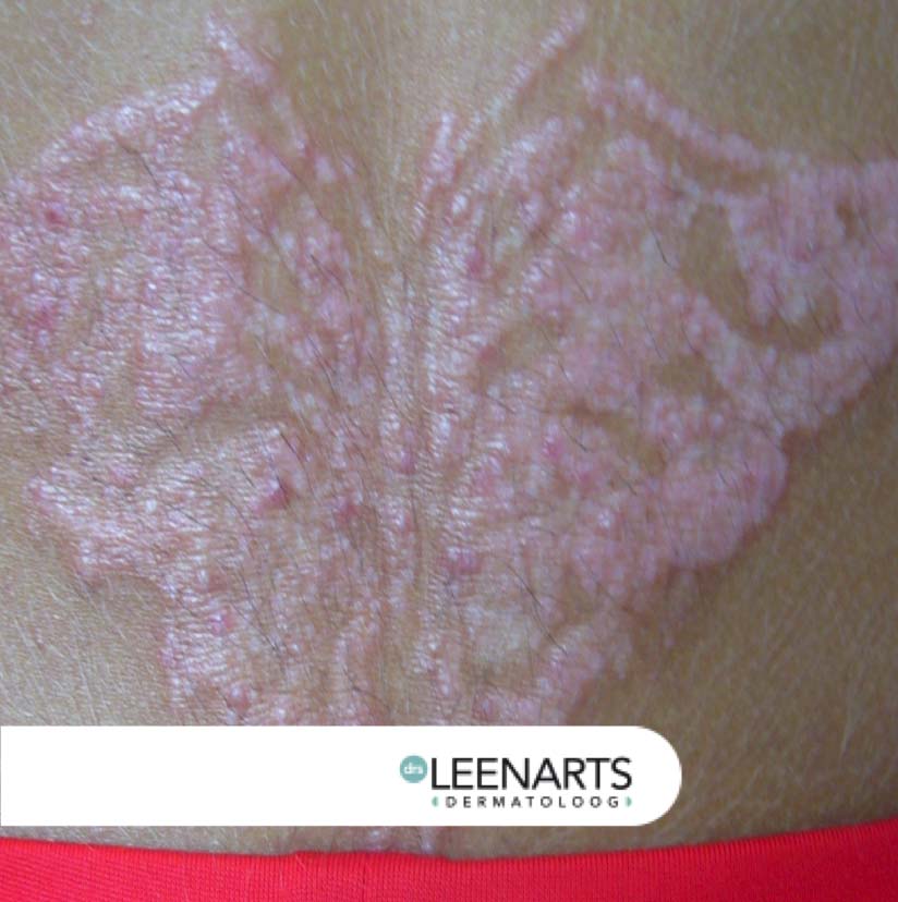 allergische reactie tattoo henna tatoeage