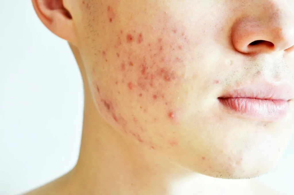acne weergegeven op huid, nederlander intolerant jegens acne-patient.