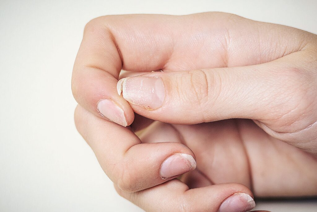 Gespleten broze nagels