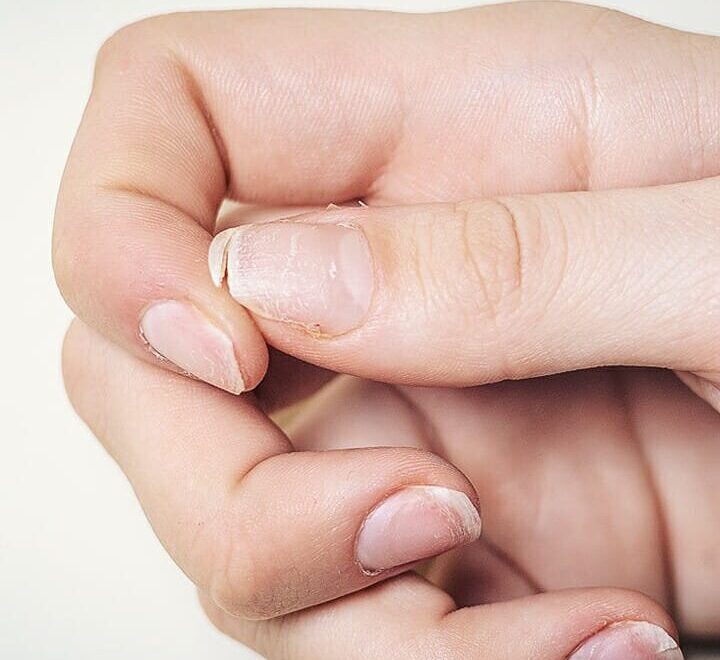 Wat kun je doen tegen droge, broze nagels?