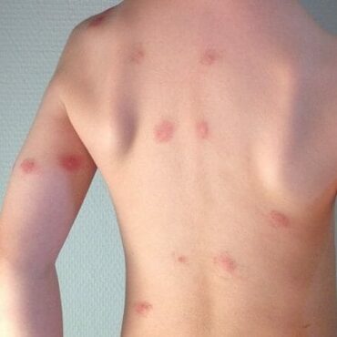 muggen steek allergische reactie strophulus