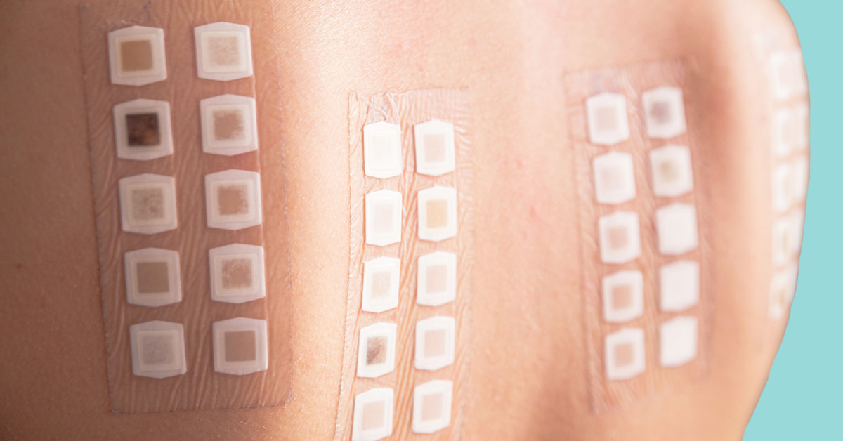 huid allergie en een allergie test op rug