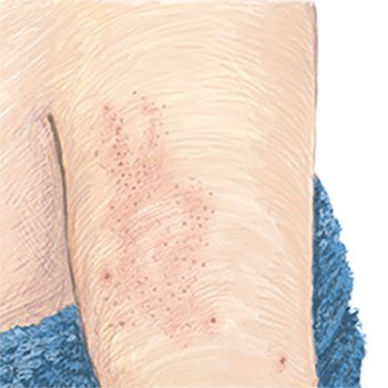 bultjes op bovenarm keratosis pilaris