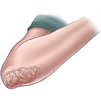 psoriasis