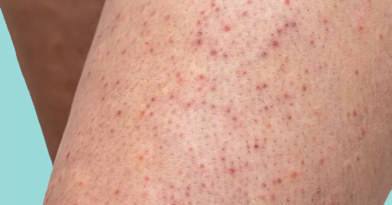 Rode bultjes op bovenarm of benen keratosis pilaris