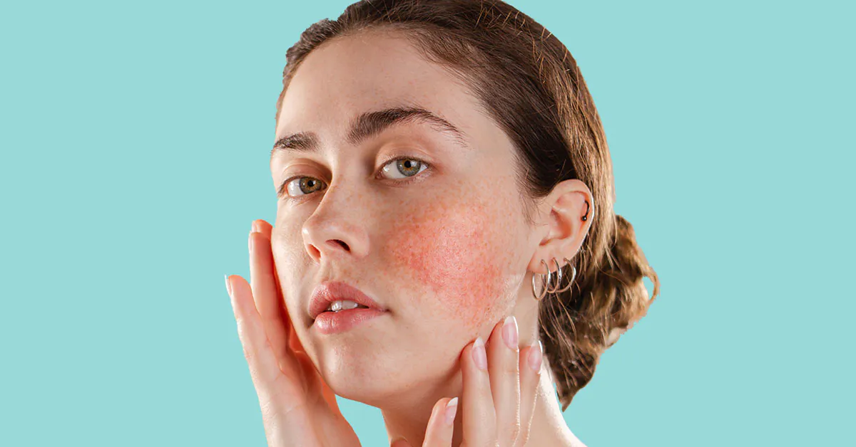 Rosacea