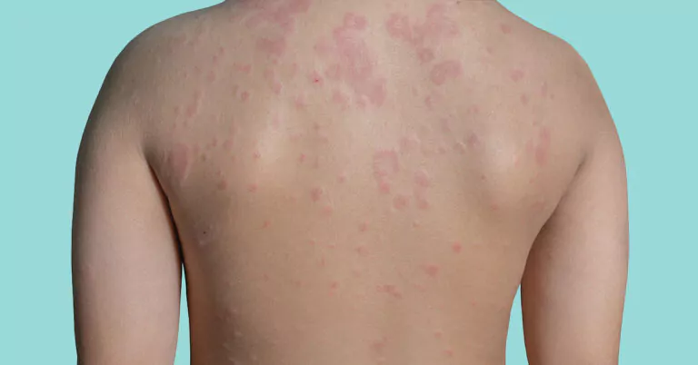 urticaria netelroos galbulten