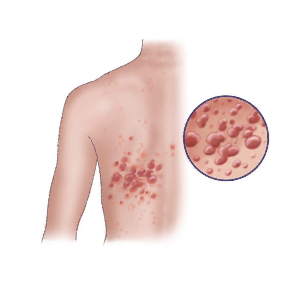 Illustratie urticaria / galbulten