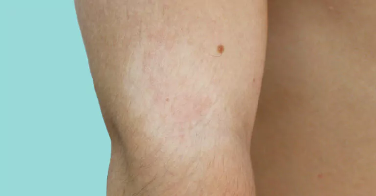 pityriasis alba voor adviespagina van drs leenarts. wiite vlekken