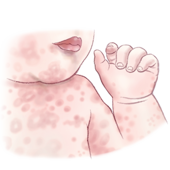 Illustratie van baby acne voor de baby acne advies van drs leenarts.