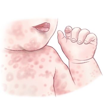 baby acne