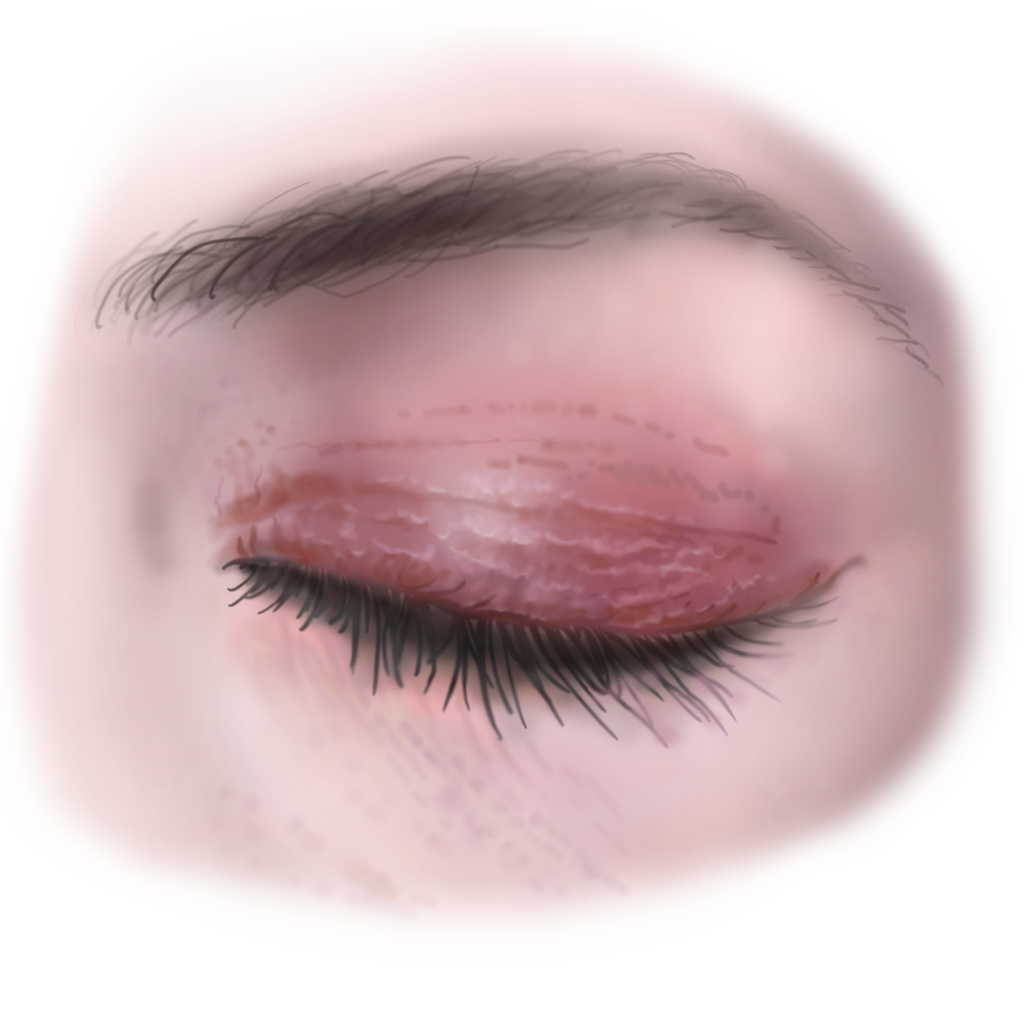 huidallergie schilferende huid bij het oog