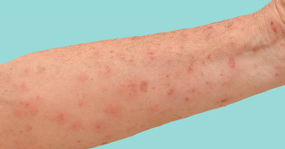 Scabies Rash Schurft Herkennen Scabies Of Schurft Symptomen Oorzaak