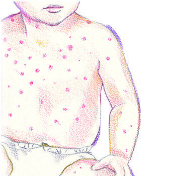 illustratie van kindje met waterpokken voor adviespagina van drs leenarts.