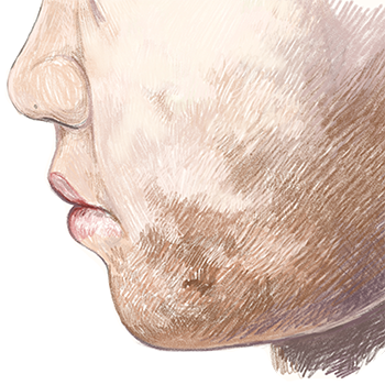 illustratie van pityriasis alba voor adviespagina van drs leenarts.