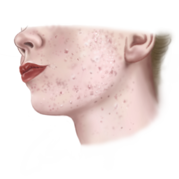 Illustratie van Acne voor de acne adviespagina.