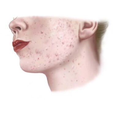 Illustratie van Acne voor de acne adviespagina.