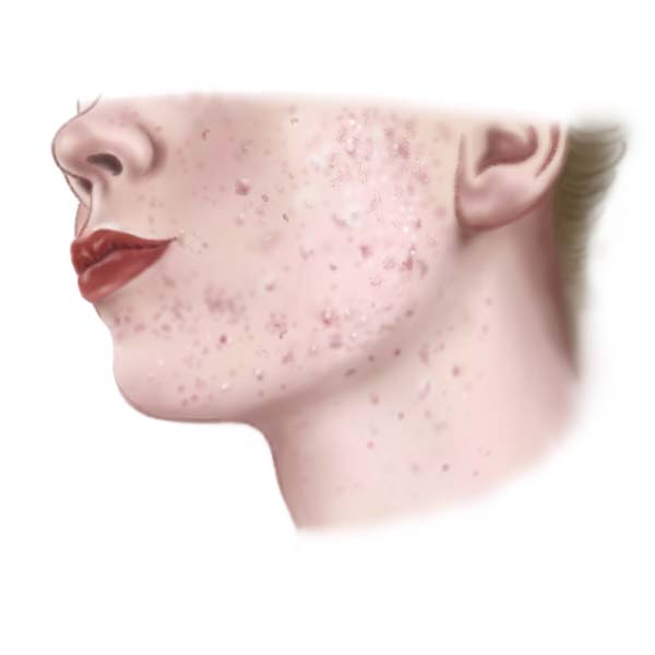 Acne Oorzaken Behandeling En Tips Drs Leenarts