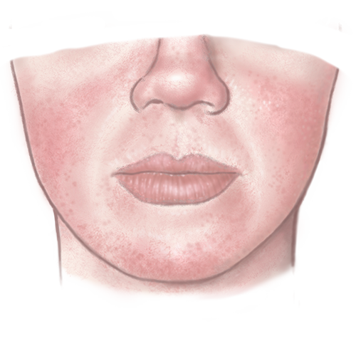Illustratie van rosacea voor de rosacea adviespagina van drs leenarts.