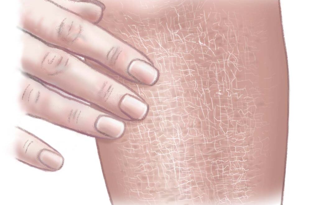  Extreem Droge Huid Oorzaak Tips I Drs Leenarts