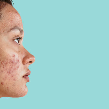 Vrouw met acne op haar gezicht