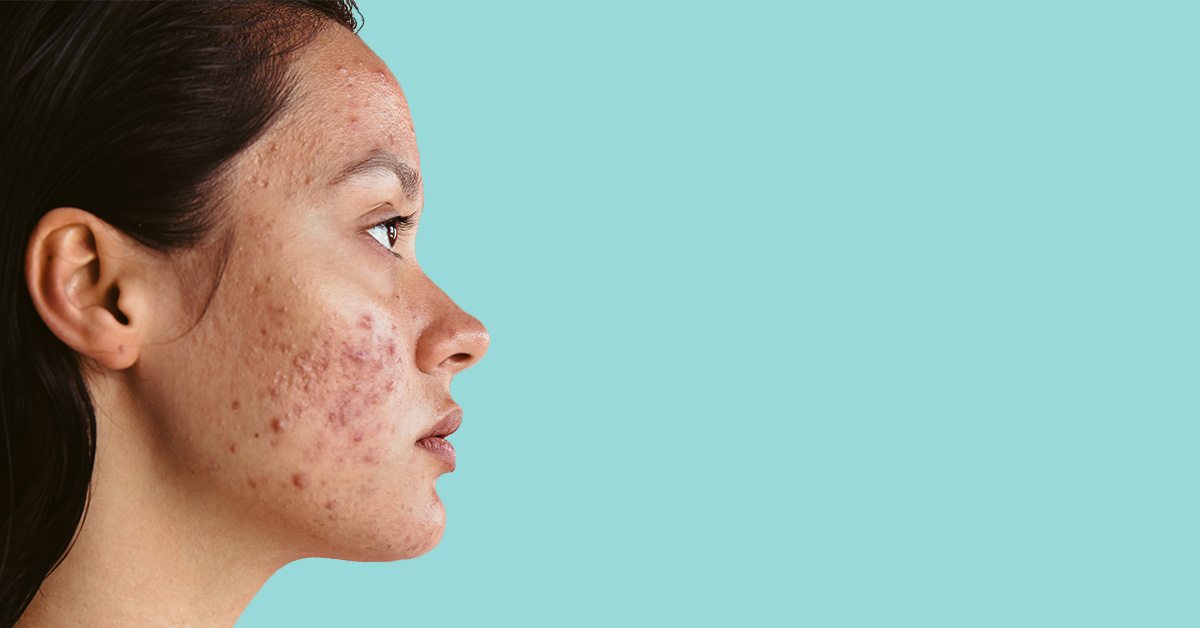 Savant Ziekte rijstwijn Acne | oorzaken, behandeling en tips | Drs Leenarts