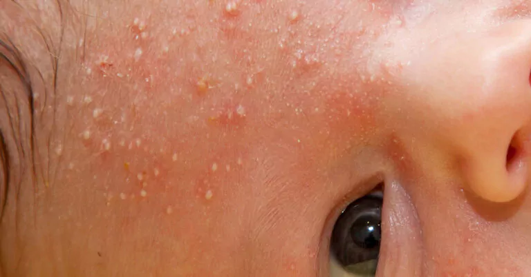 baby acne