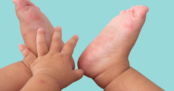 Advies bij warmte-uitslag baby | Drs Leenarts