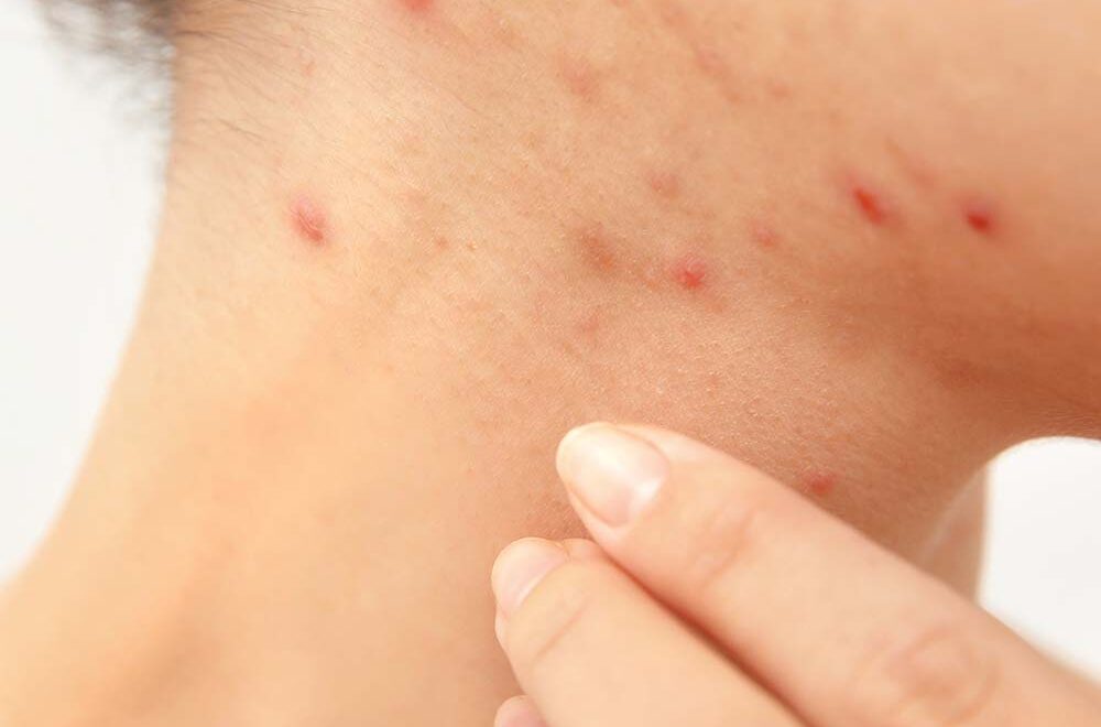 9 tips van je dermatoloog bij acne