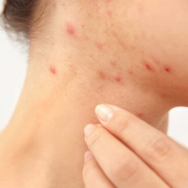 acne tips van een dermatoloog