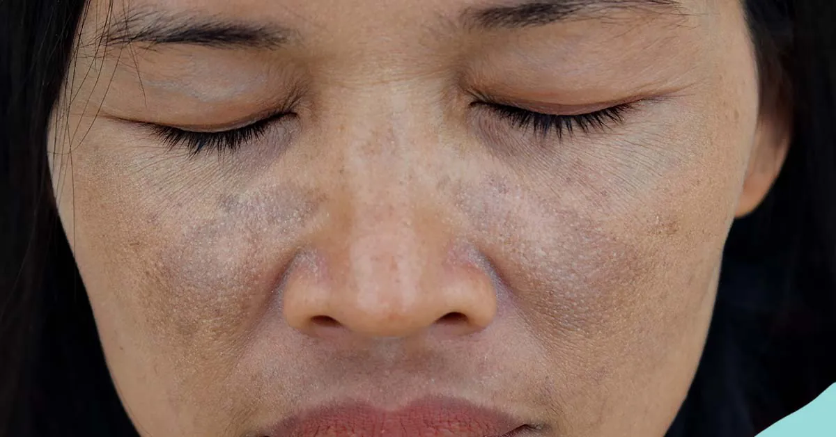 Melasma