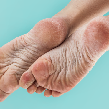 Droge voeten | Symptomen & tips wat te doen | Drs Leenarts