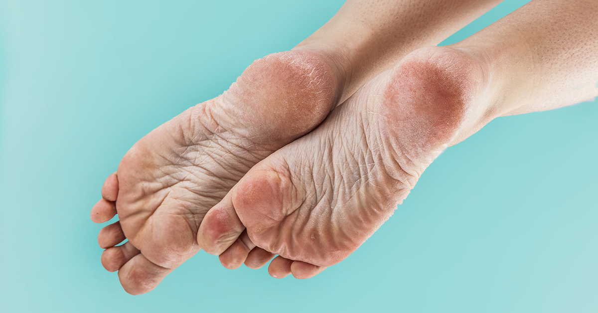 overschot Penelope ramp Droge voeten | Symptomen & tips wat te doen | Drs Leenarts