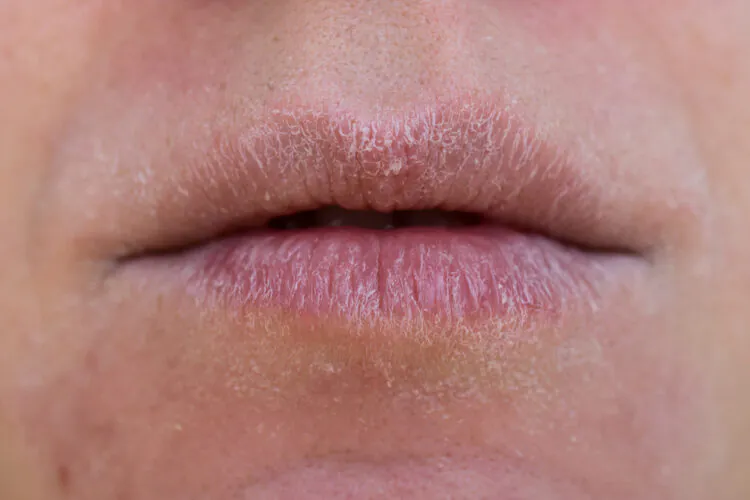 Tips bij droge huid, lippen en handen in de herfst