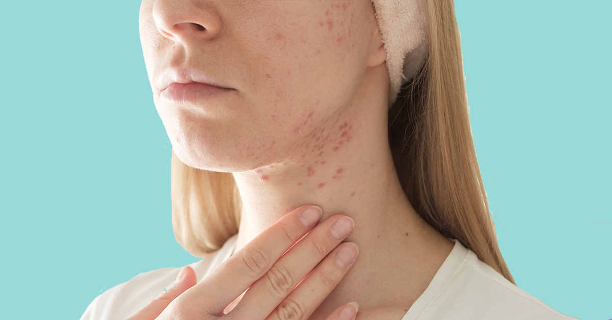 Puisten in je nek? Tips van je dermatoloog