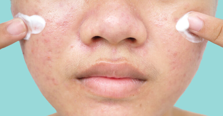 Blog acne zonnebrand puist - Drs Leenarts
