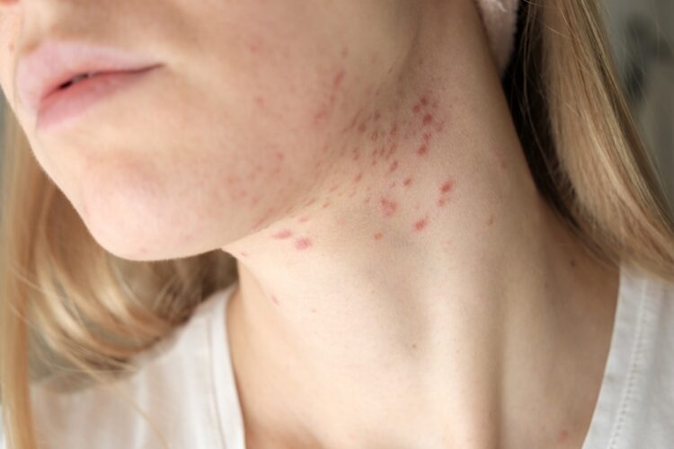 Puisten in je nek? Tips van je dermatoloog