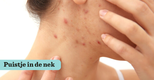 Last van puisten in je nek? Bekijk onze tips | Drs Leenarts
