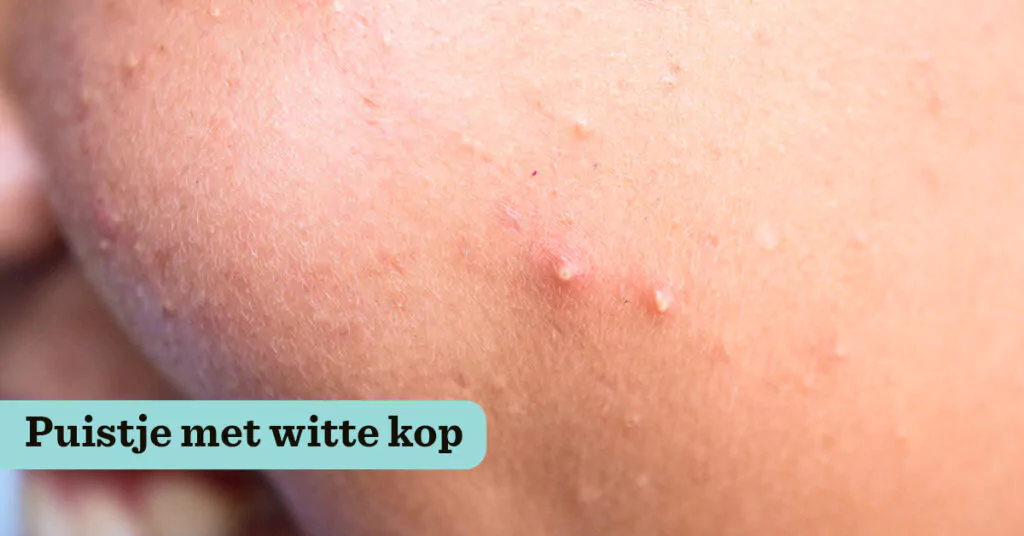 Puistje met witte kop | Drs Leenarts